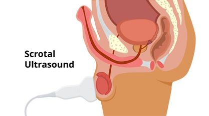 Picture4 | drmanishamehta.com Illustration of a male pelvis showing a scrotal ultrasound probe on the scrotum during the examination.