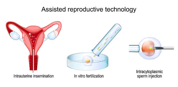Assisted reproductive technology: intrauterine insemination, in vitro fertilization in a dish, and intracytoplasmic sperm injection.